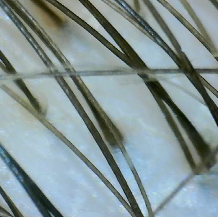 Диагностика кожи головы трихоскопом