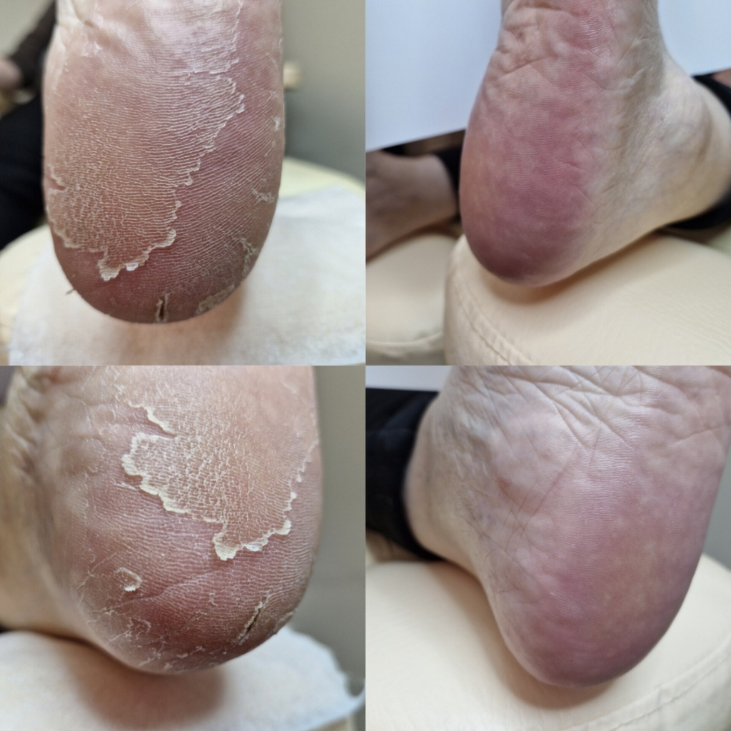 Гигиеническая обработка стоп и ногтей (без покрытия)