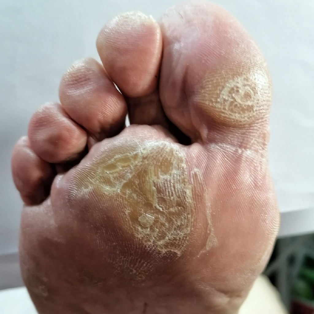 Сложная обработка стоп и ногтей