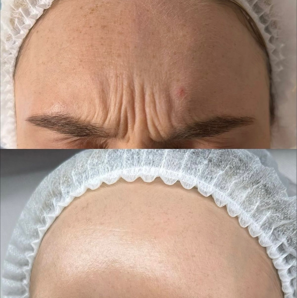 Ботокс лоб,м/б,глаза