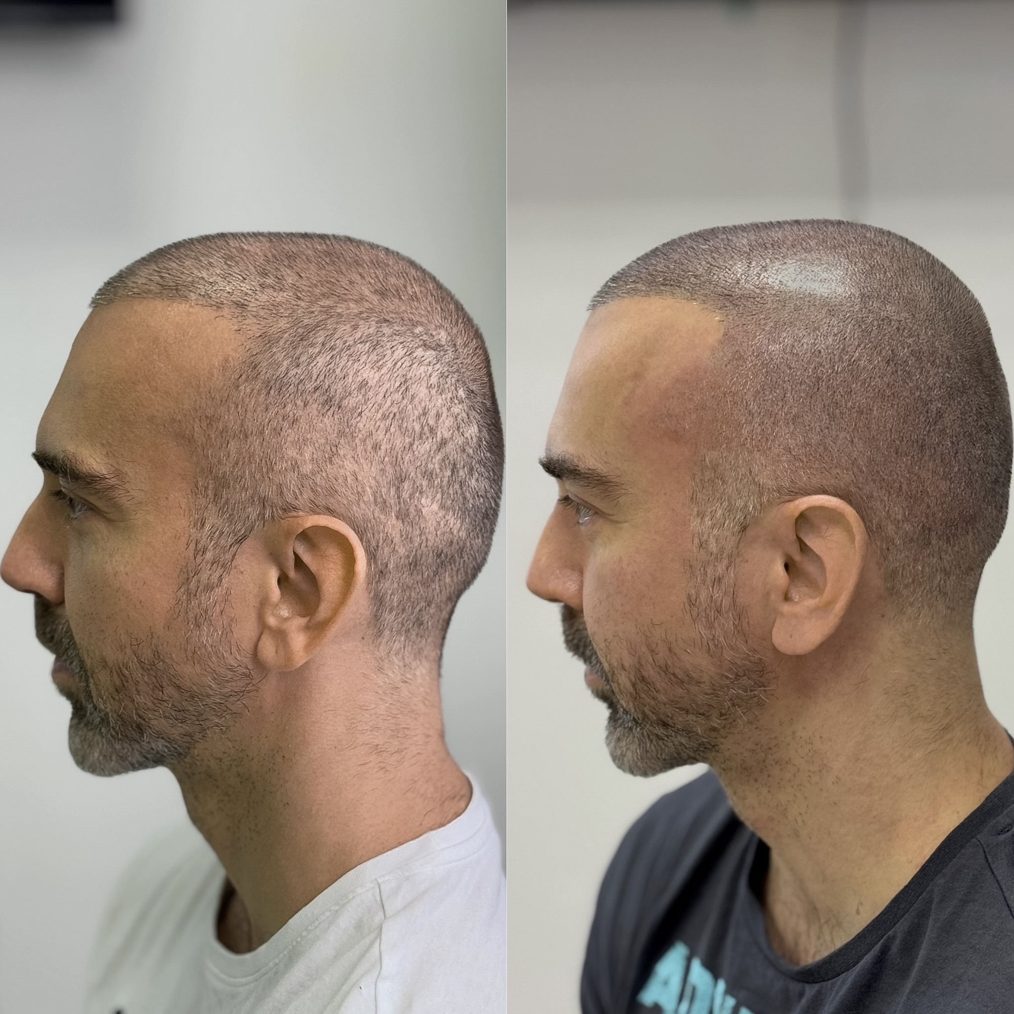 Перекрытие шрамов на голове