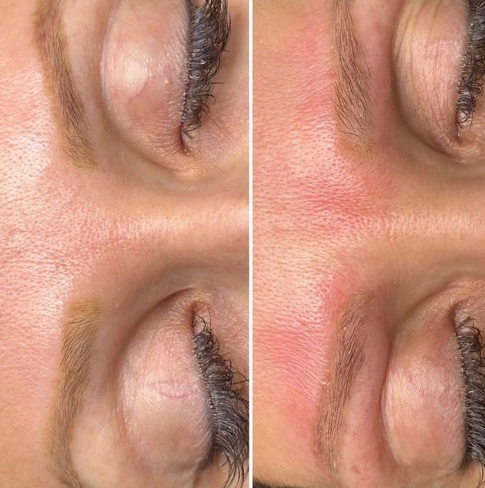 Удаление татуажа