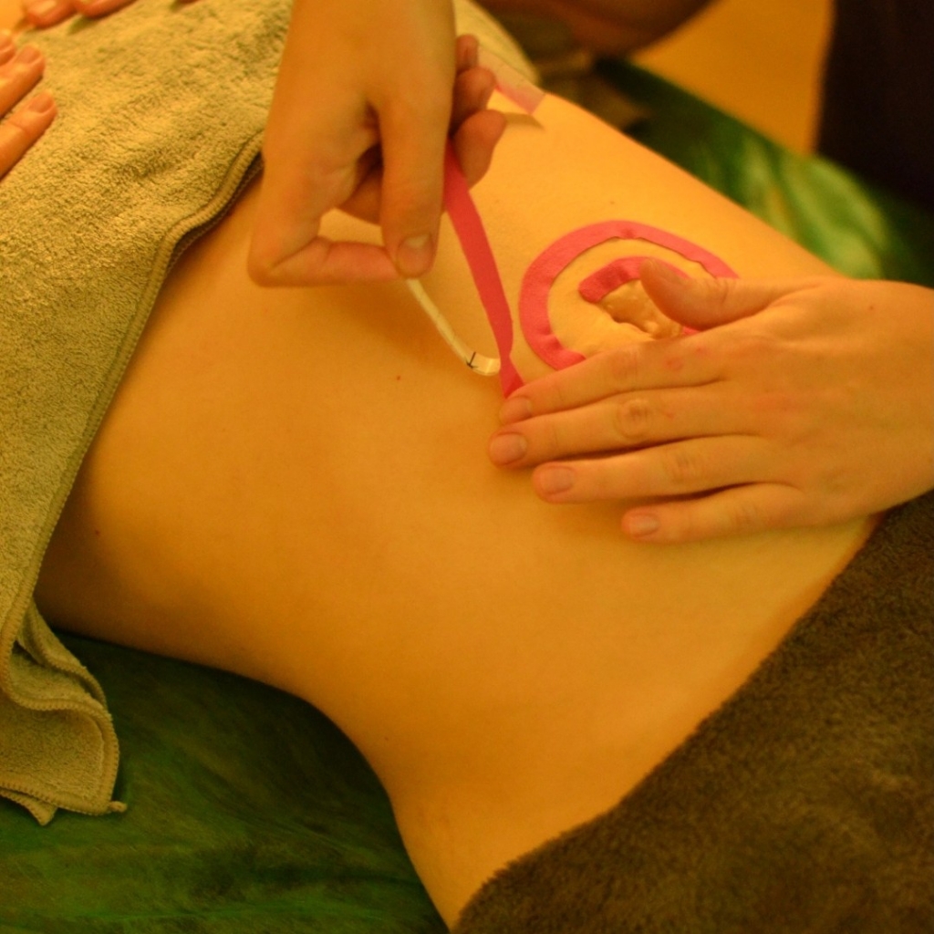 Эстетическое тейпирование