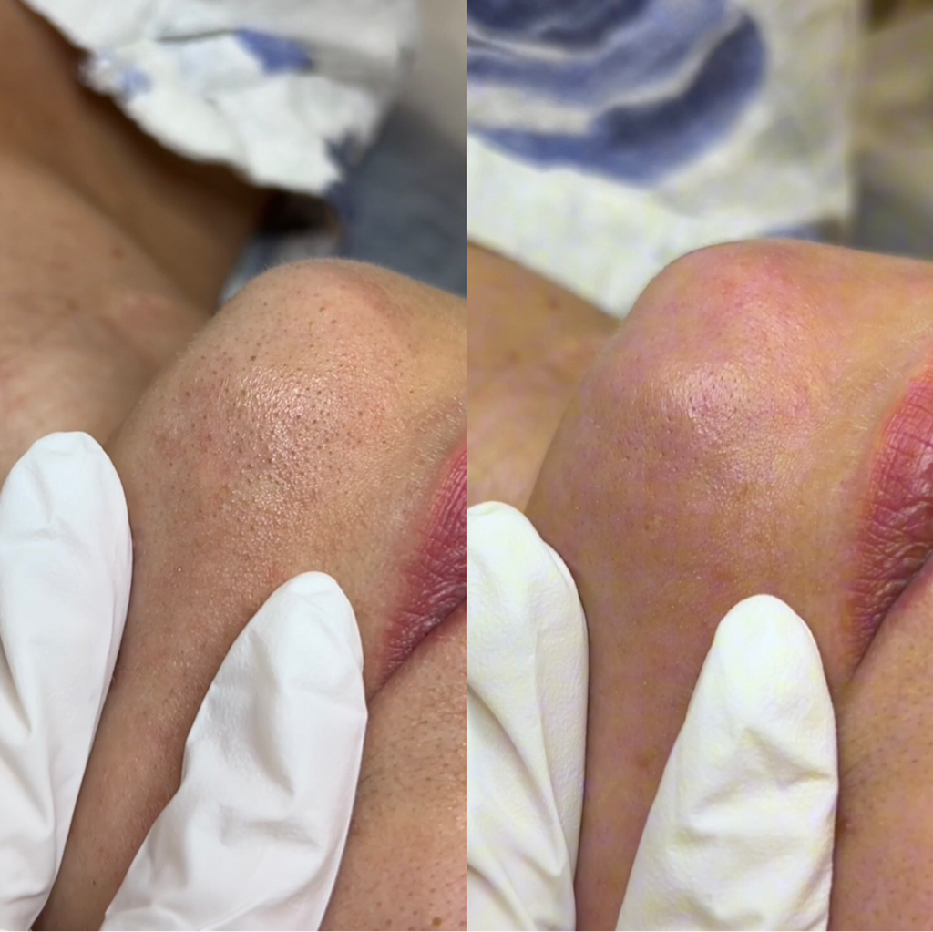 Комбинированная чистка лица