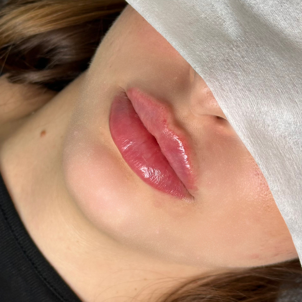 Увеличение губ 0,5 мл