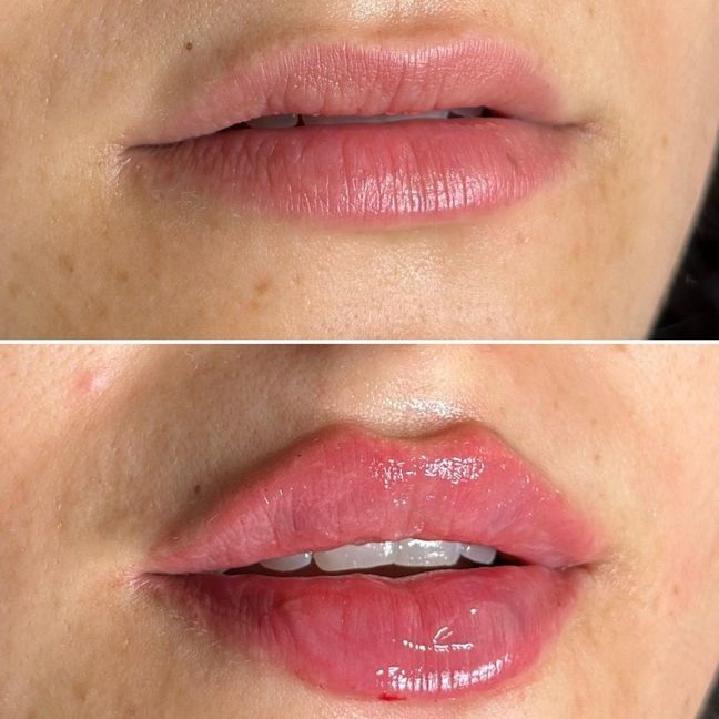 Увеличение губ в Краснодаре