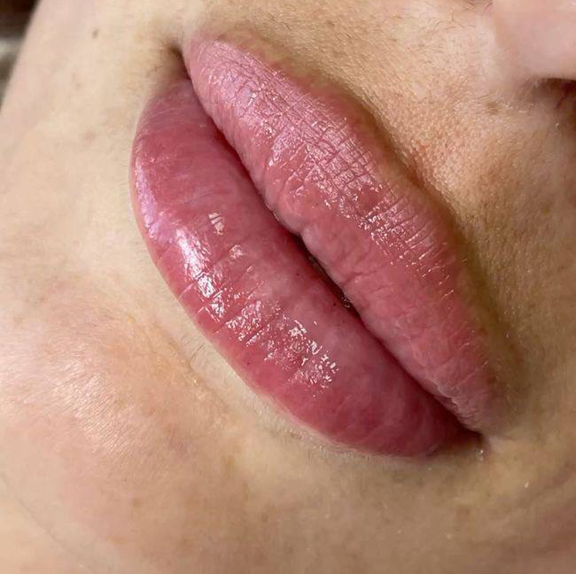 Биоревитализация, увлажнение губ