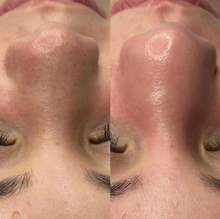 Чистка лица+закрывающий пилинг