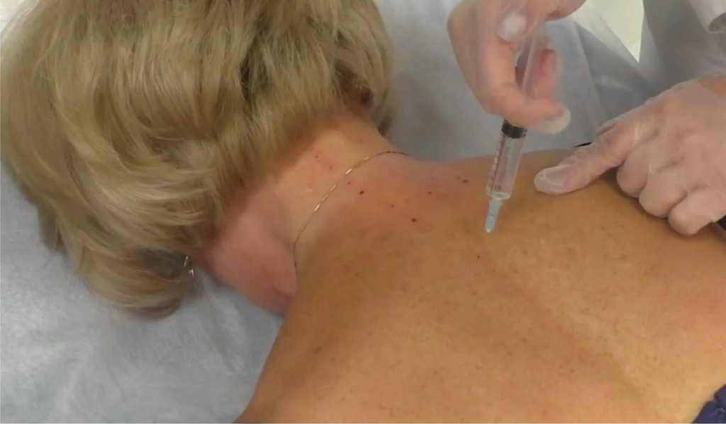 Капилляромезотерапия