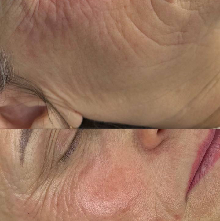 Коллагеновая стимуляция