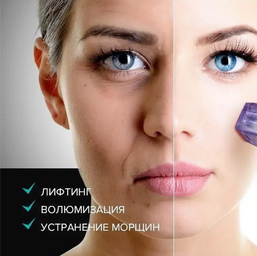 Микроигольчатый рф-лифтинг Тело( живот, руки, кисти рук, ноги)