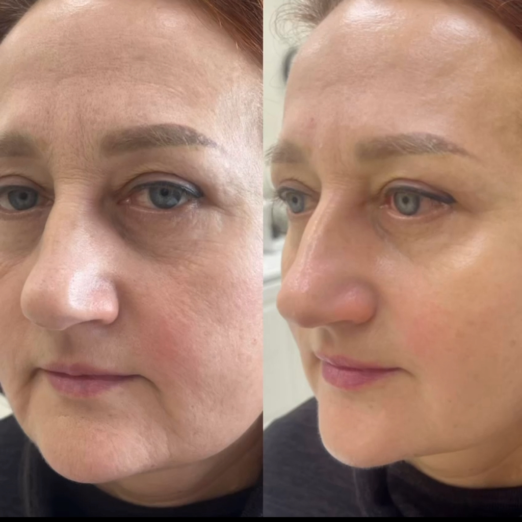 Hydrofacial - аппаратная чистка с проф процедурами