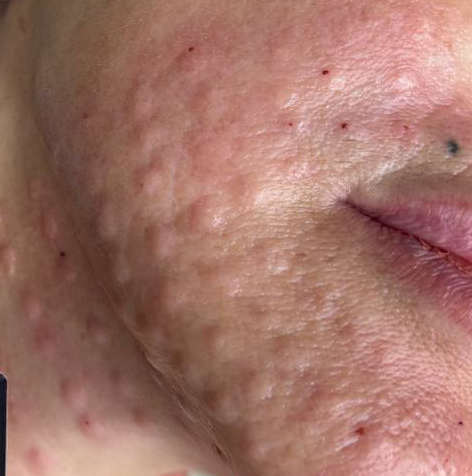 Биоревитализация