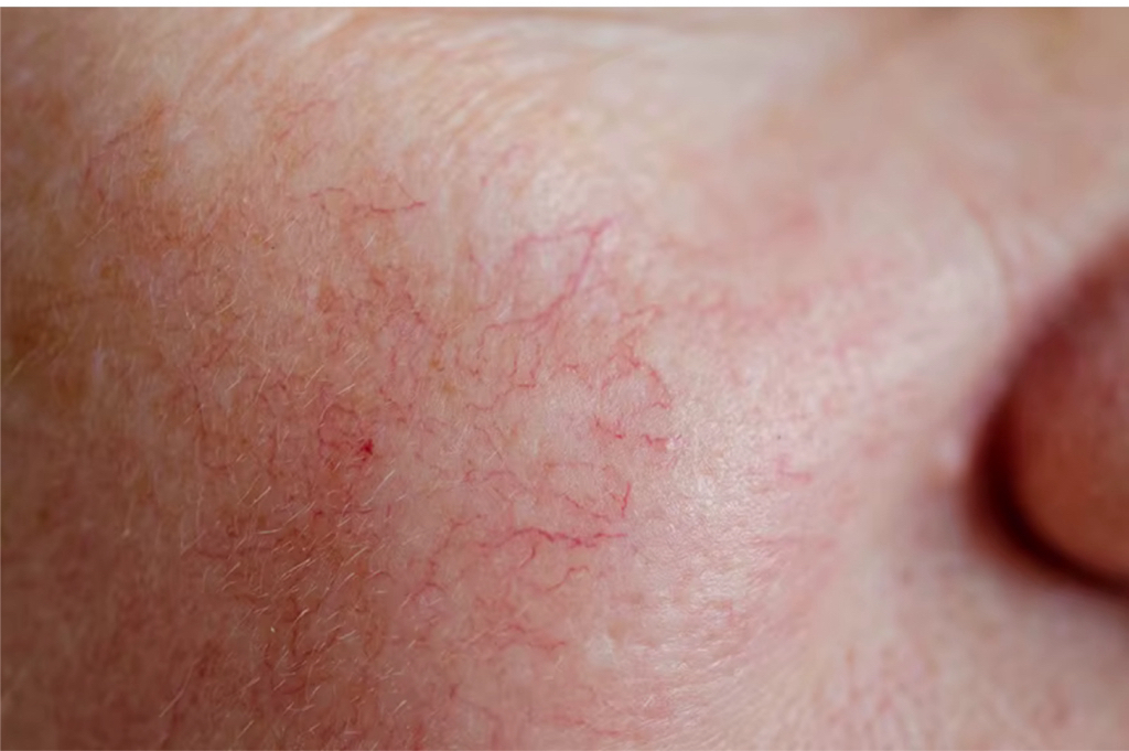 Антикупероз