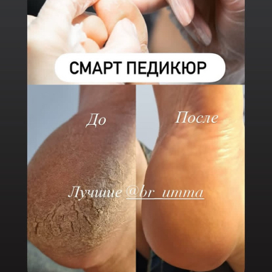 Смарт-педикюр