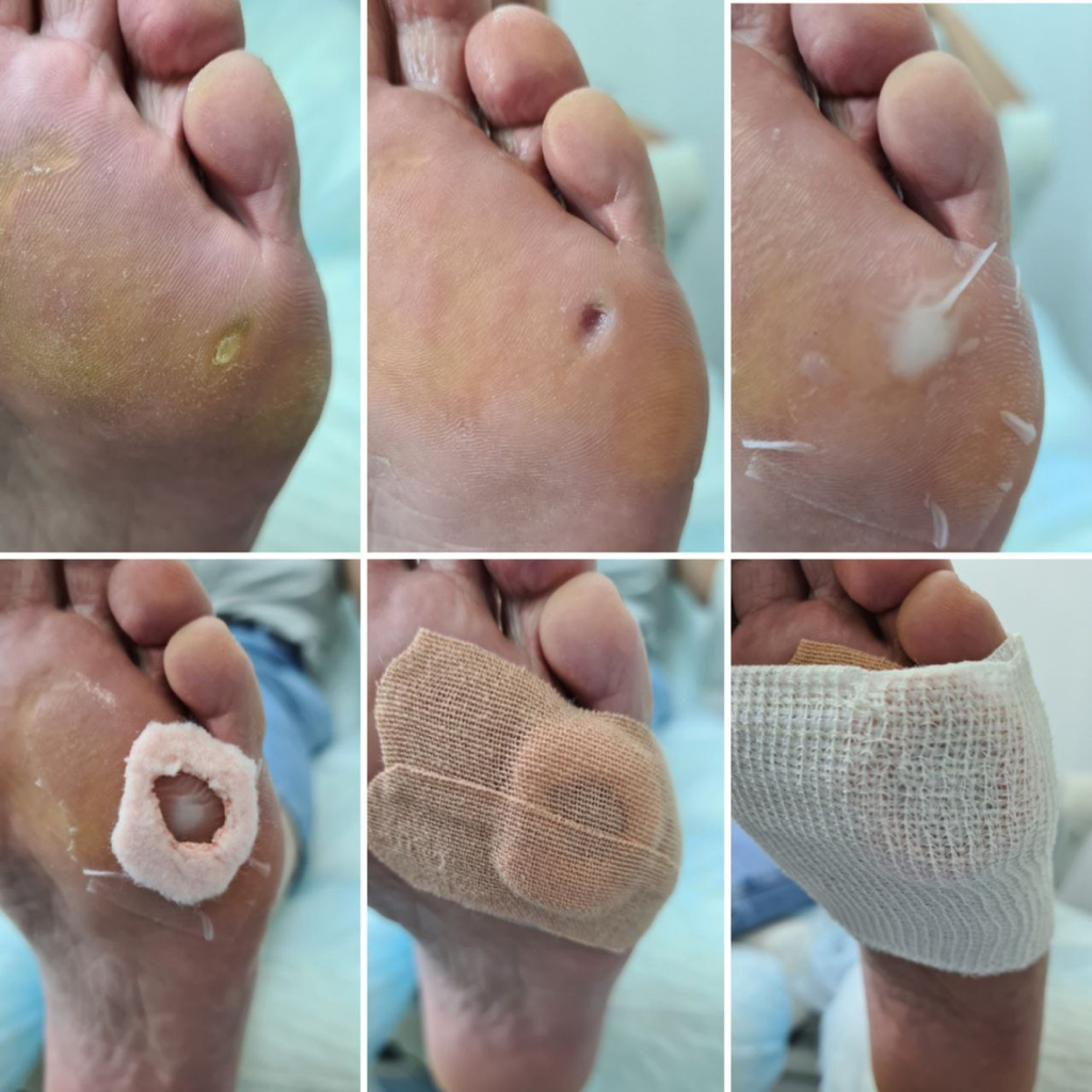 Обработка стержневой мозоли  (зачистка,разгрузка)