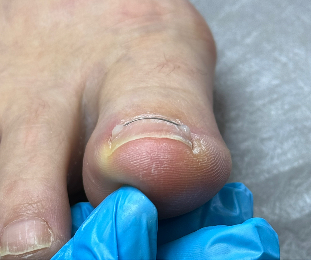 Установка  титановой  нити