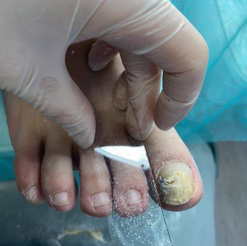 Забор биоматериала на исследование (от сложности)