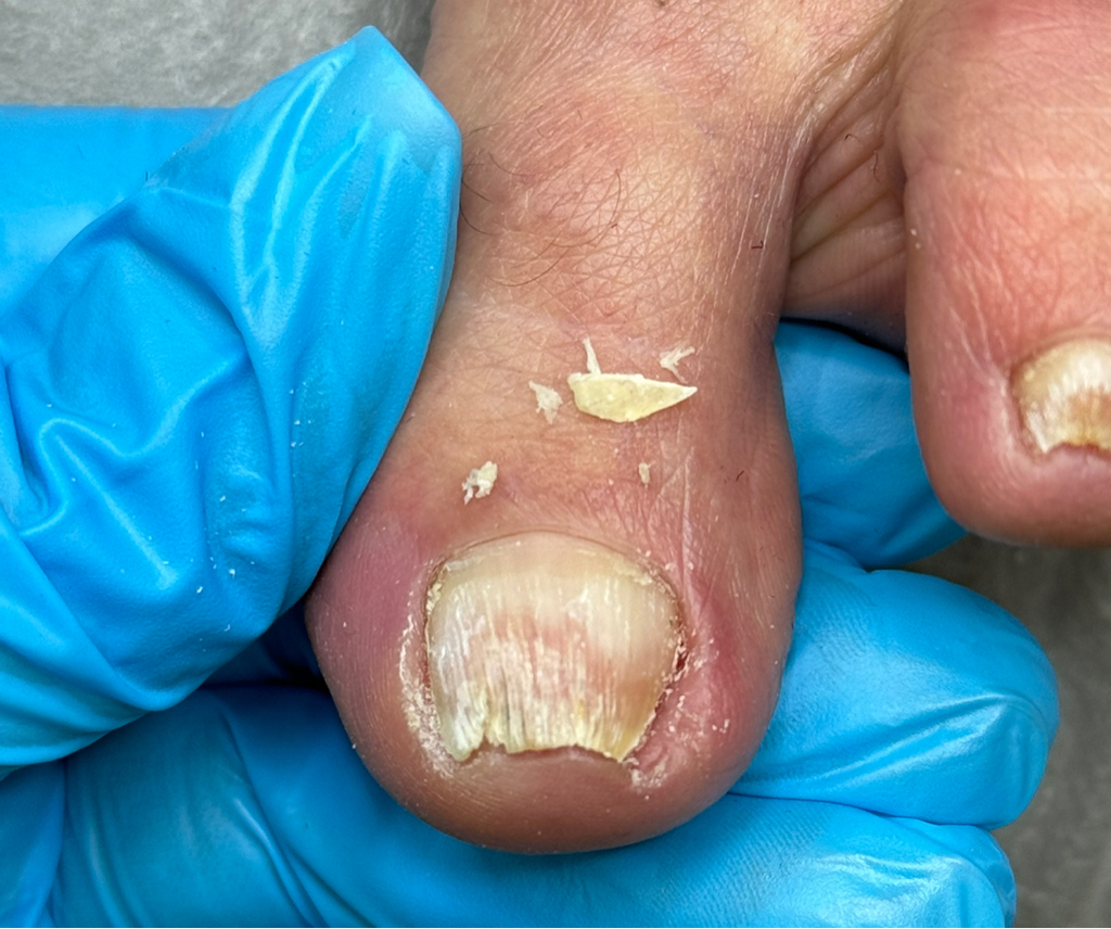 Извлечение вросшего ногтя (извлечение сегмента,обработка,повязка)