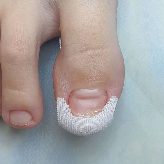 Тейпирование