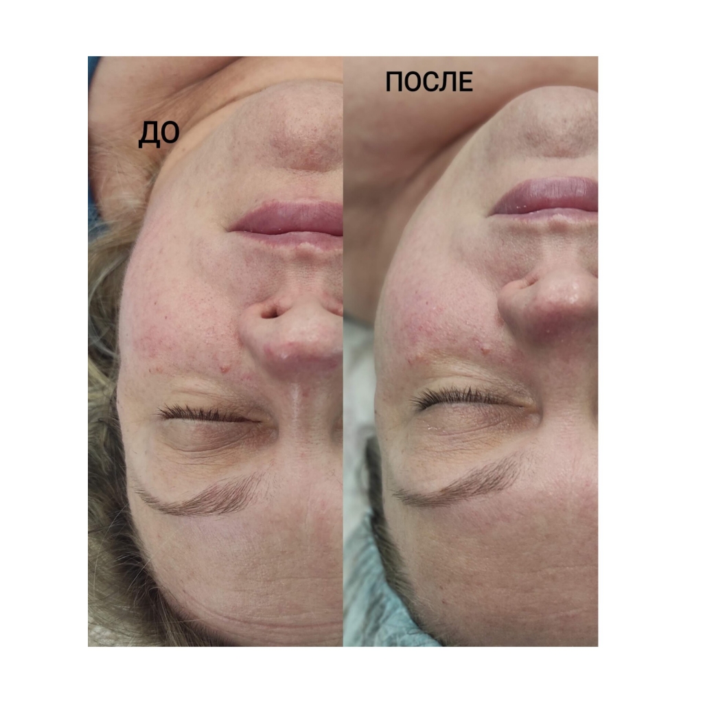 RF лифтинг