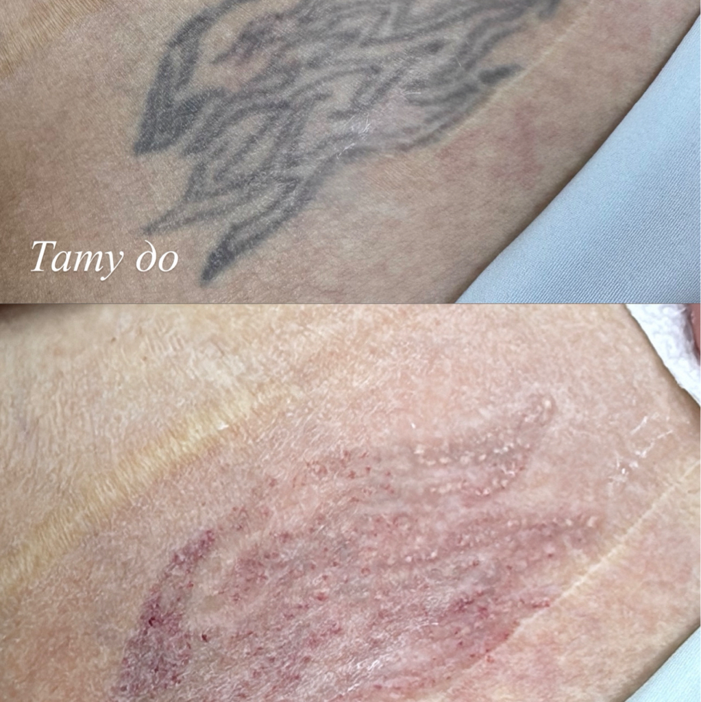 Удаление тату