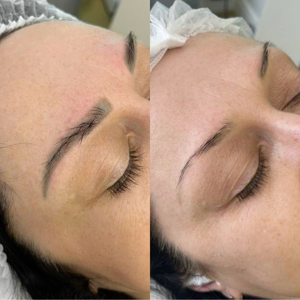 Удаление перманентного макияжа