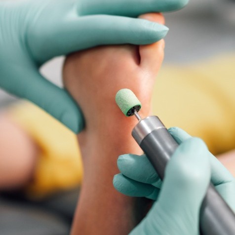 Подологический педикюр(удаление мозолей,натоптышей)