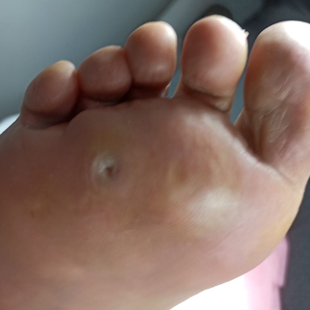 УДАЛЕНИЕ(ЛЕЧЕНИЕ) СТЕРЖНЕВОЙ МОЗОЛИ