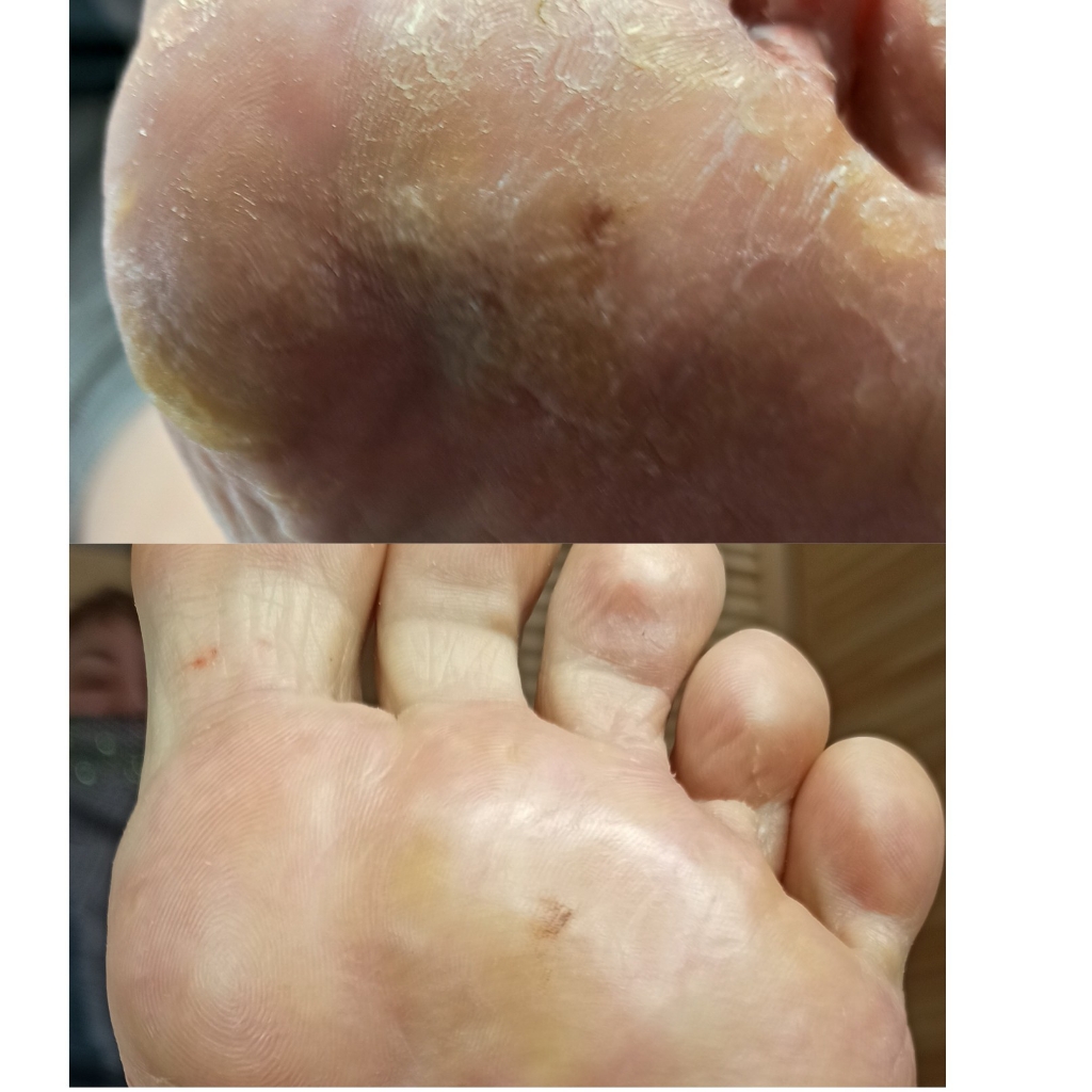 ПОДОЛОГИЧЕСКИЙ ПЕДИКЮР СТОПА+ПАЛЬЧИКИ (консультация, глубокие трещины, стержневые мозоли, вросший ноготь, зачистка ногтей, разгрузка и т.п)