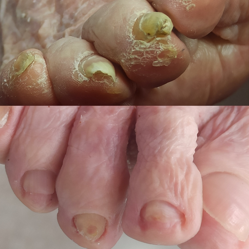 ЗАЧИСТКА НОГТЕЙ (онихомикоз, онихолизис, онихогрифоз)