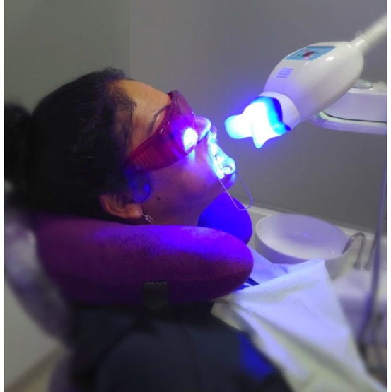 Косметическое отбеливание зубов