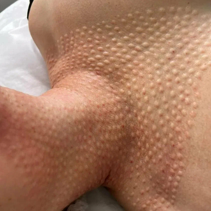 Биоревитализация шея ,декольте