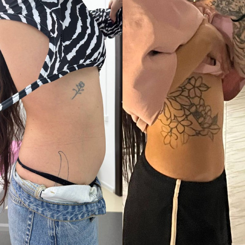 Липолитическая терапия