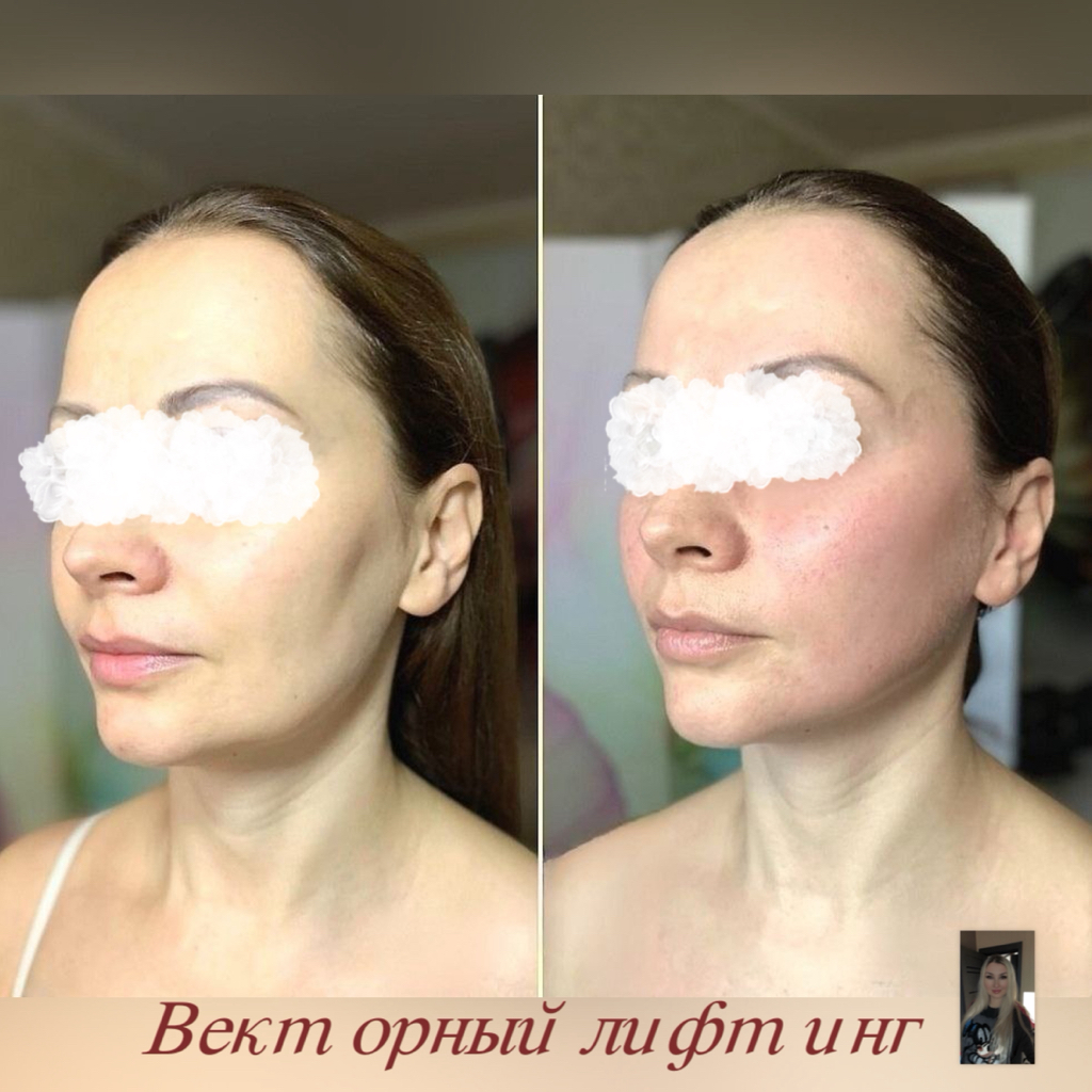 Векторный лифтинг (Гидроксиапатит кальция) 1,5мл