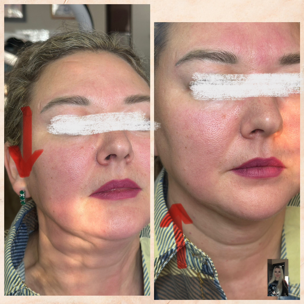 Full-Face (токсин)