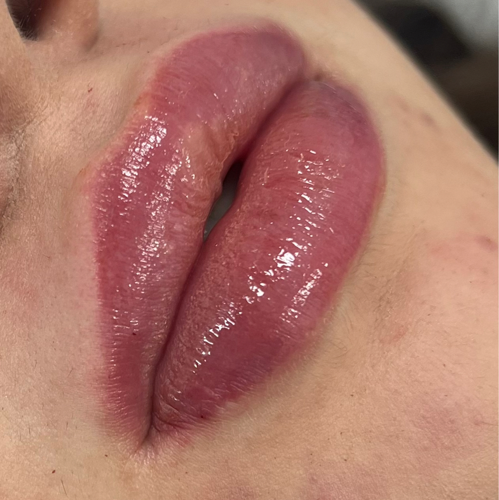 Увеличение губ (Франция, Испания)