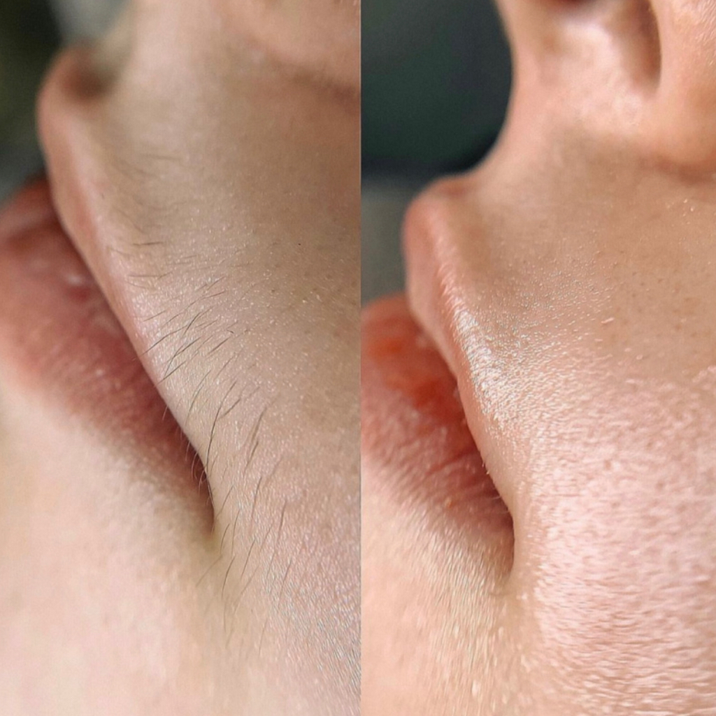 УДАЛЕНИЕ НЕЖЕЛАТЕЛЬНЫХ ВОЛОС (воск)