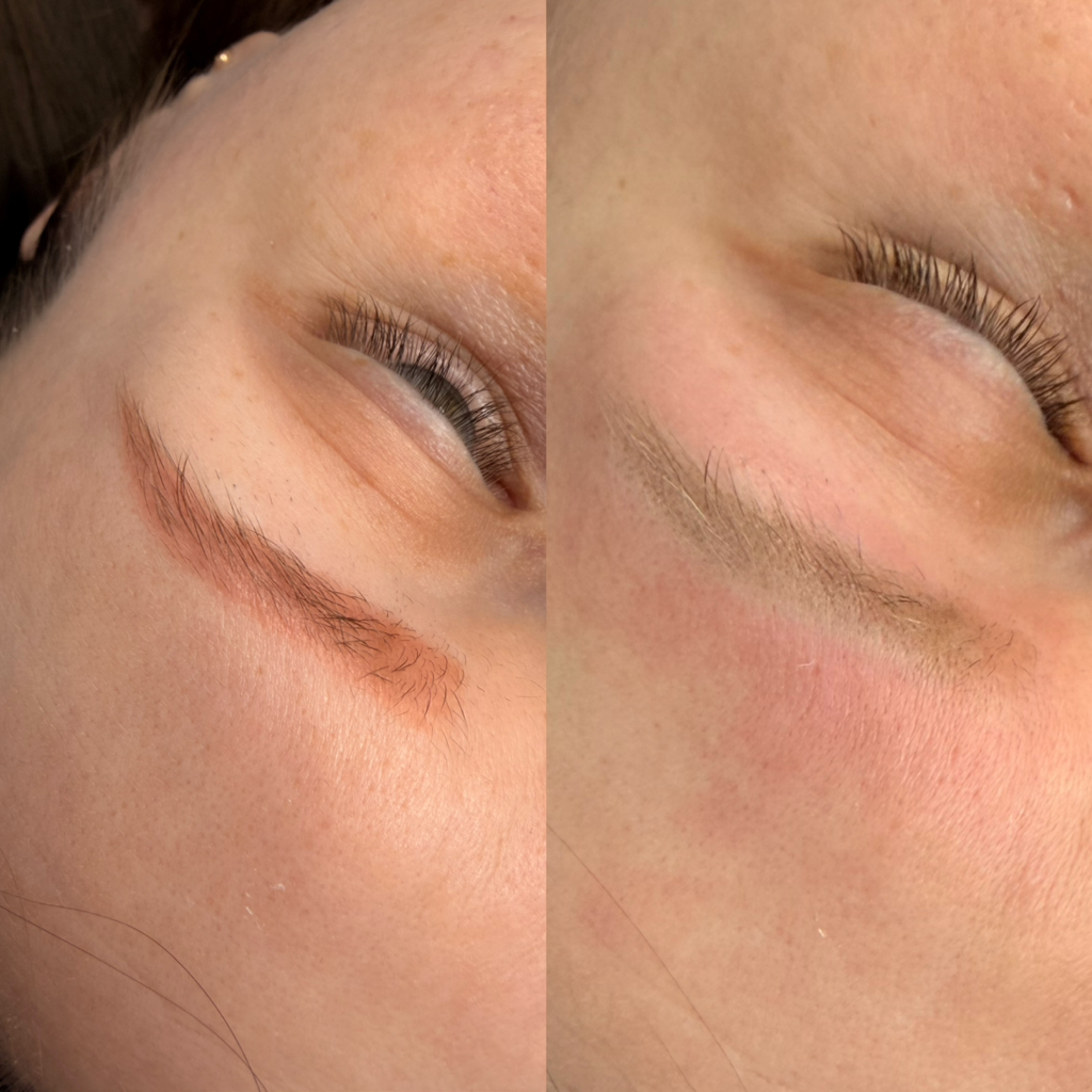 Удаление татуажа/ тату лазером (повторная процедура)