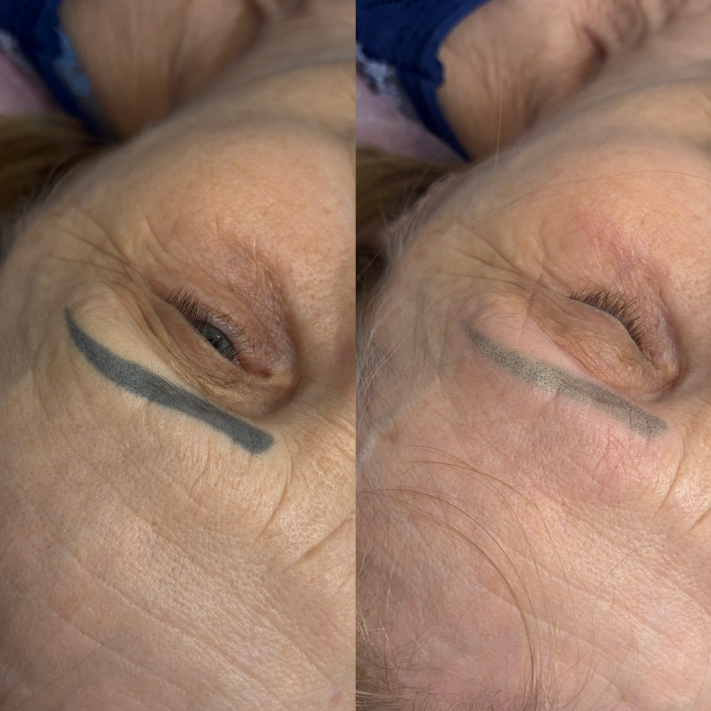 Удаление татуажа /тату (ПЕРВИЧНАЯ ПРОЦЕДУРА)  Консультация, составление плана удаления