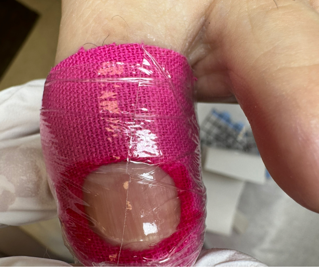 Окклюзионная повязка