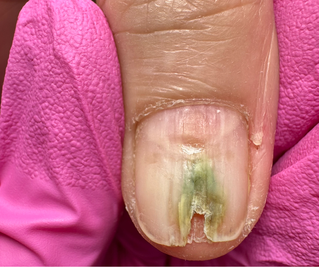 Обработка онихолизиса и ногтей с присоединением инфекции на руках (1-2 ногтя, без выполнения маникюра)