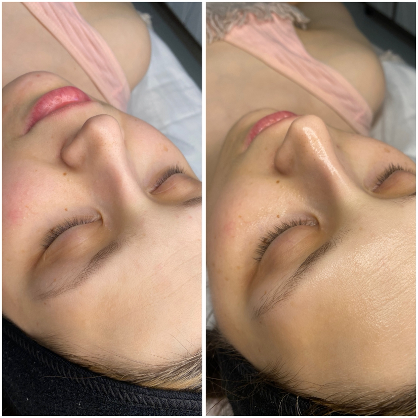 Уходовая программа  “DOLPHIN SKIN”🐬+ УЗ чистка носа в 🎁