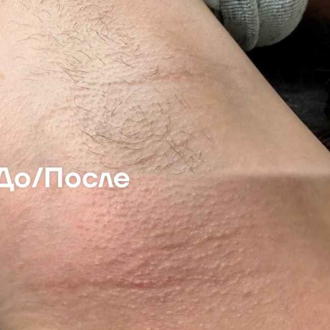 Шугаринг/депиляция подмышечных впадин