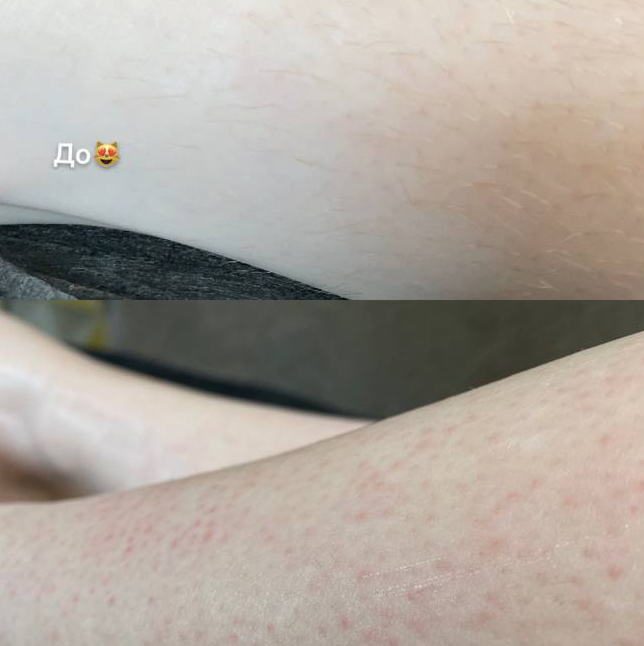 Шугаринг/депиляция ног полностью