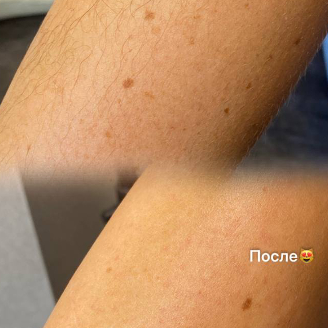 Шугаринг/депиляция рук полностью