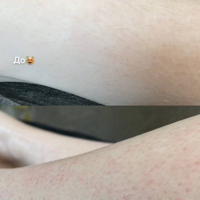 Шугаринг/депиляция голеней