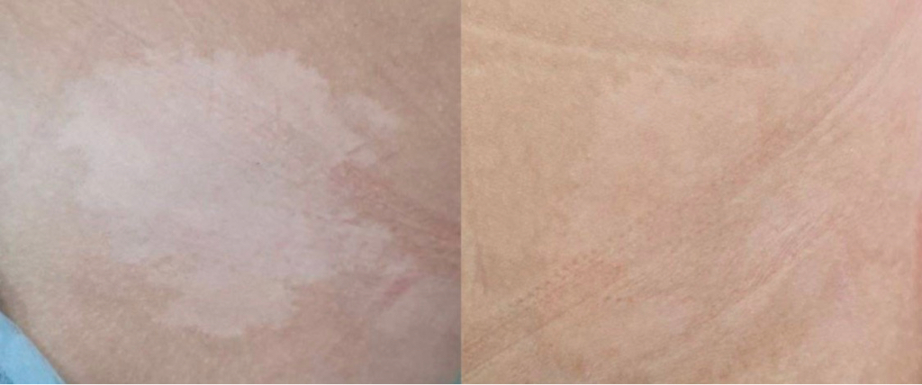 Коррекция Камуфляжа рубцов, шрамов, растяжек, витилиго  от 1 месяца до 3 месяцев. Только своих выполненных работ.