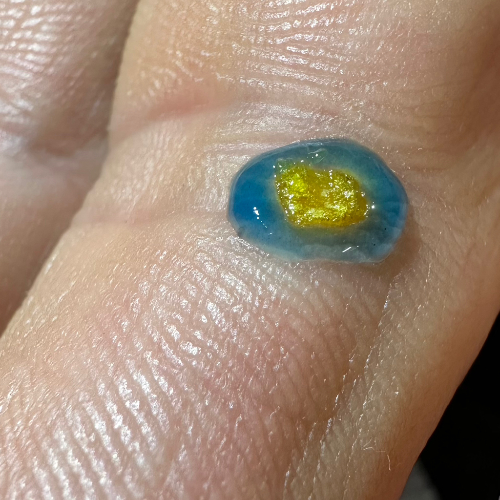 Удаление бородавки