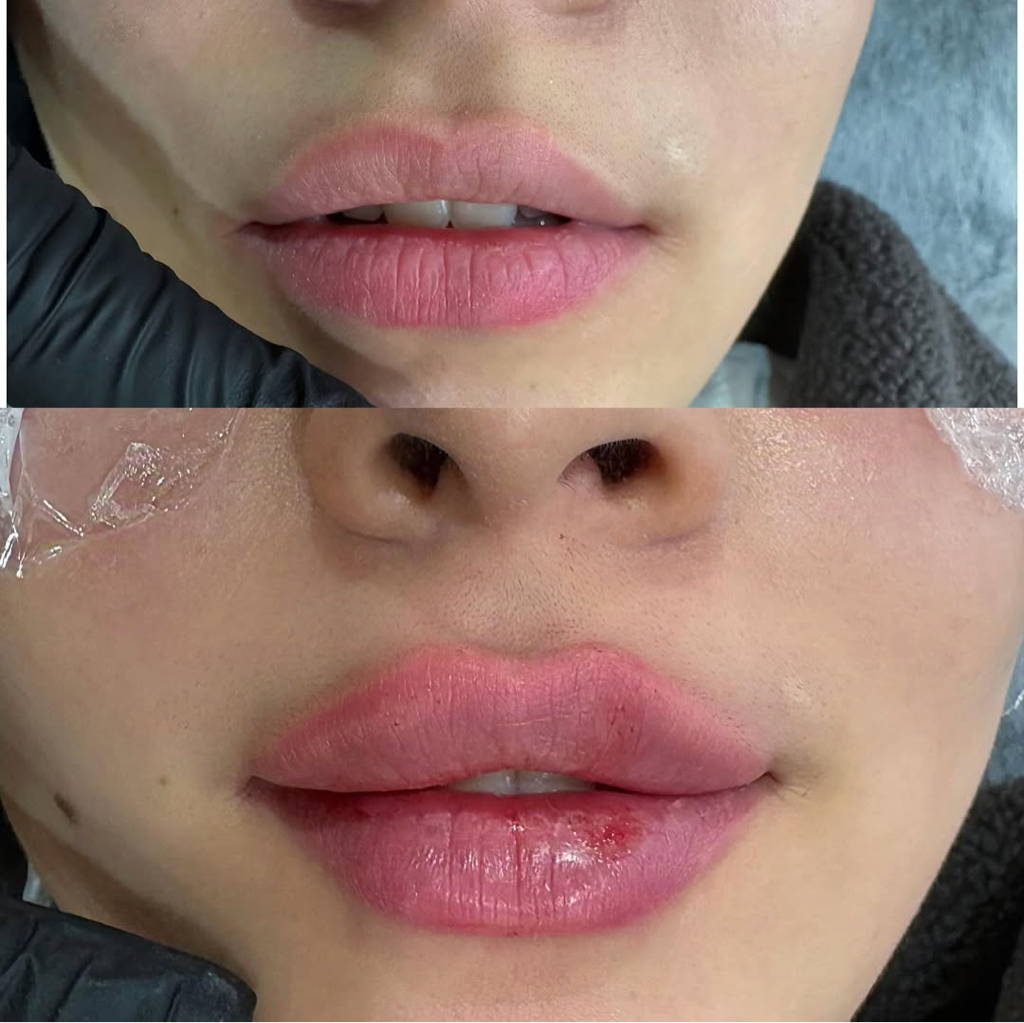 Увеличение губ